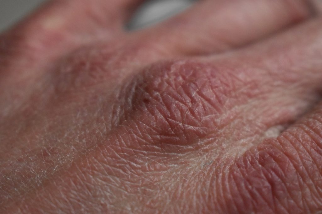 photo of person’s dry hands